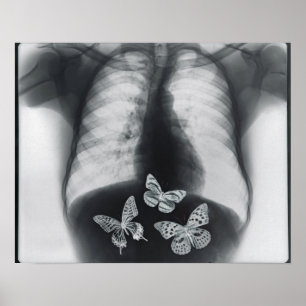 Röntgenfoto van vlinders in de maag poster