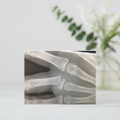 röntgengebroken bot wordt snel goed briefkaart (Staand voorkant)