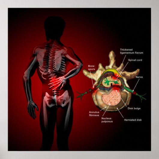 Rugpijn Poster (Voorkant)
