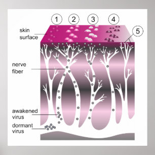 Schema van de progressie van gordelroos op de huid poster