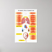 Schema van een amniotisch vochtembolie AFE Canvas Afdruk (Voorkant)