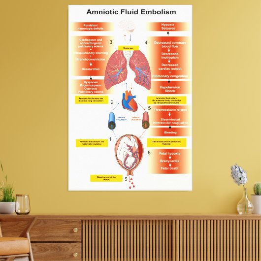 Schema van een amniotisch vochtembolie AFE Canvas Afdruk (Insitu (Woonkamer))