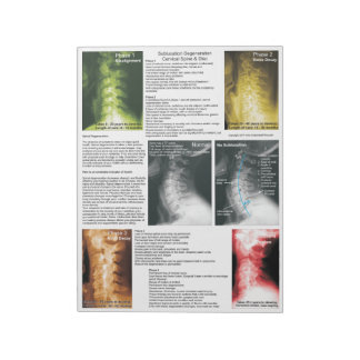 Scheur uit Pad subluxe cervicale degeneratie Notitieblok