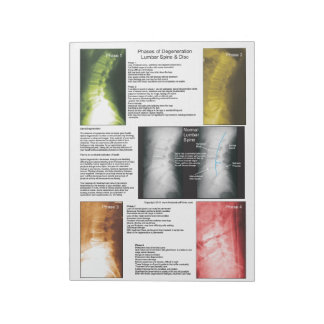 Scheur uit poot Lumbar Spinale degeneratie Notitieblok