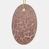 Schildkliercellen met kanker keramisch ornament (Links)