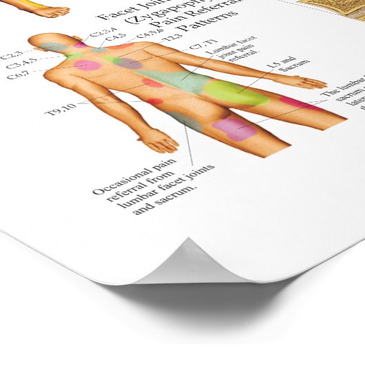 Sclerotome Visceral Pain Poster de référence (Coin)