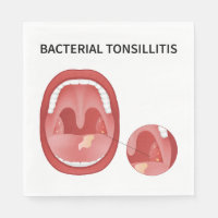 Ttonsillite bactérienne