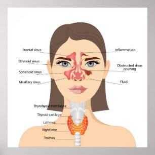Sinusitis Poster