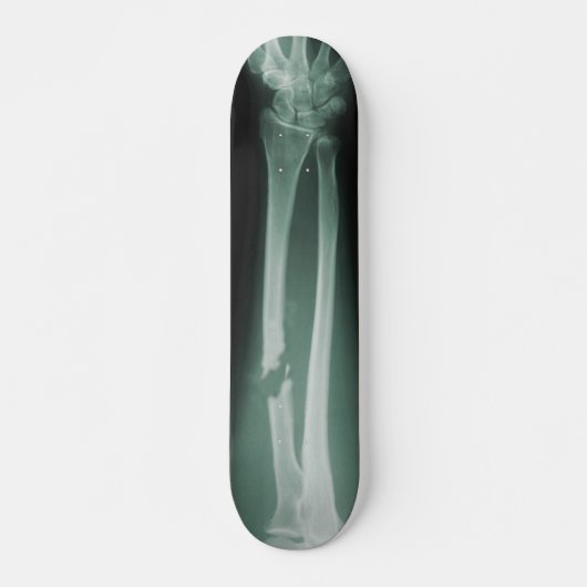 Skateboard Os cassés (Devant)