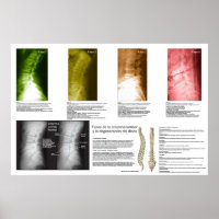 Spaandegeneratie Poster in Spaanstalige fase