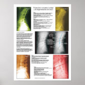 Spanish Phases Lumbar Spinal Degeneration Poster (Devant)