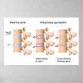 Spine Ankylose spondylitis Poster (Devant)