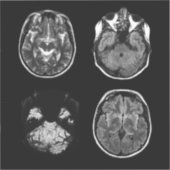 Sticker Analyse IRM du cerveau (Recto)