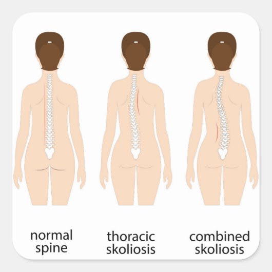 Sticker Carré Déformité de la colonne vertébrale (Devant)