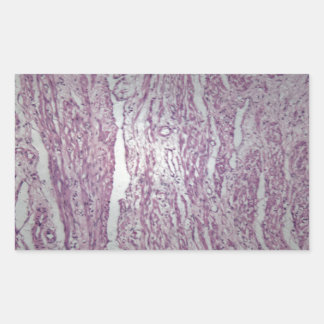 Sticker Rectangulaire Cellules de tissu utérin humain avec tumeur inoffe