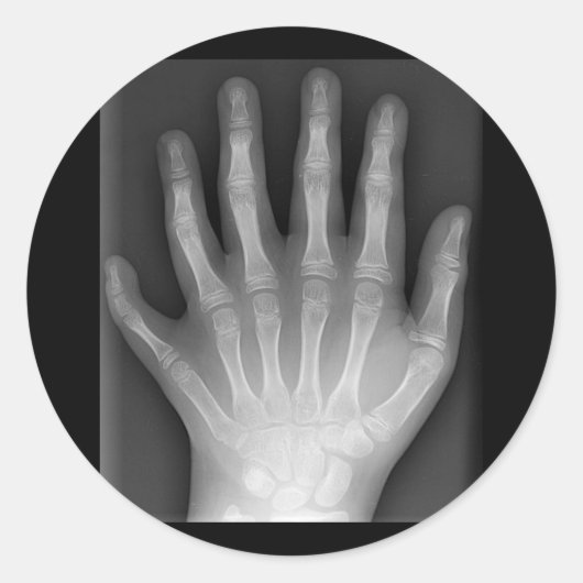 Sticker Rond Polydactylo, Six Doigts, X-Ray, rareté ! (Devant)