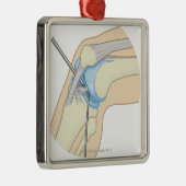 Stijve endoscopie metalen ornament (Rechts)