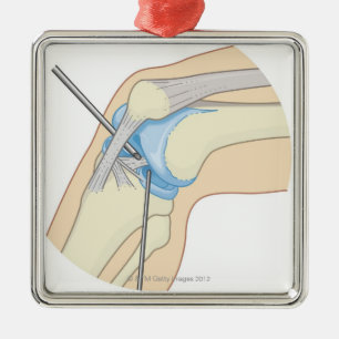 Stijve endoscopie metalen ornament