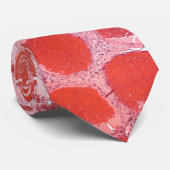 Stropdas hemangioom pathologie (Opgerold)