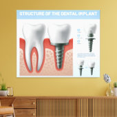 Structuur van het tandheelkundig implantaat canvas afdruk (Insitu (Woonkamer))