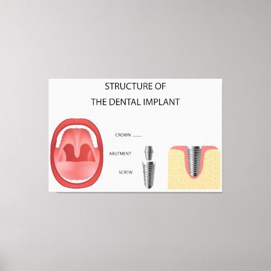Structuur van tandheelkundig implantaat canvas afdruk (Voorkant)