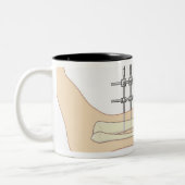 Tasse 2 Couleurs Fixator externe (Gauche)