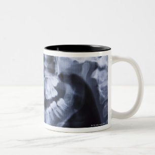 Tasse 2 Couleurs Rayon X d'un menton de filles pris avec un