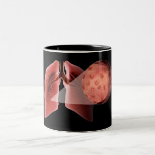 Tasse 2 Couleurs Voie aérienne d'Inflammed pendant une crise