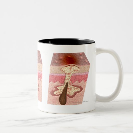 Tasse 2 Couleurs Vue de ce qui cause l'acné (Droit)
