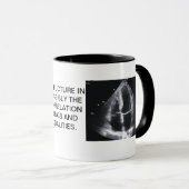 TASSE CARDIAQUE D'ÉCHO (Devant droit)