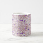 Tasse de café - leucémie myéloïde chronique (CML) (Centre)