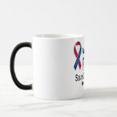 Tasse idiopathique de conscience de fibrose (Gauche)