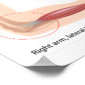 Tennis coude Sport blessure Poster (Coin)