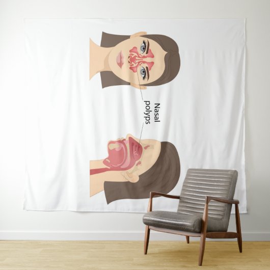 Tenture polypes nasaux (En situation (horizontale))