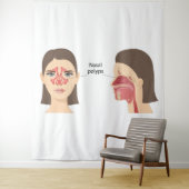 Tenture polypes nasaux (En situation)