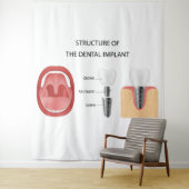 Tenture Structure de l'implant dentaire (En situation)
