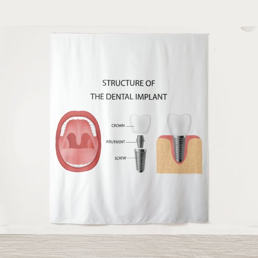 Tenture Structure de l'implant dentaire (Devant)