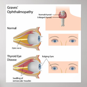 Thyroïd eye disease Poster