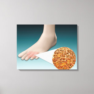 Toile Anatomie de champignon de pied avec le plan