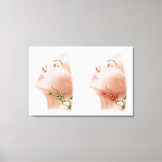 Toile Anatomie Des Noeuds Lymphe Gonflés (Recto)