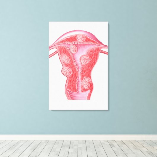 Toile Anatomie Des Tumeurs Fibroïdes Dans L'Utérus Fémin (Insitu (Plancher de Bois))