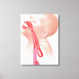 Toile Anatomie d'une fistule Tracheoesophageal