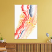 Toile Développement De La Fistule (Insitu(Salon))