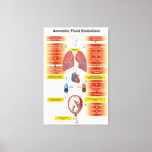 Toile Diagramme d'un embolisme amniotique de fluides AFE (Recto)