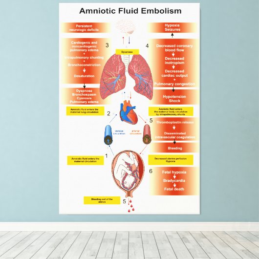 Toile Diagramme d'un embolisme amniotique de fluides AFE (Insitu (Plancher de Bois))