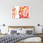 Toile Illustration De La Diverticulose Dans Le Colon (Insitu(Chambre))