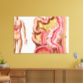 Toile Illustration De La Diverticulose Dans Le Colon (Insitu(Salon))