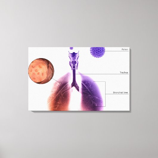 Toile Illustration d'une crise d'asthme causée par le po (Recto)