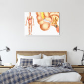 Toile Illustration Médicale D'Un Appendice (Insitu(Chambre))