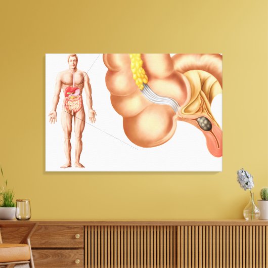 Toile Illustration Médicale D'Un Appendice (Insitu(Salon))